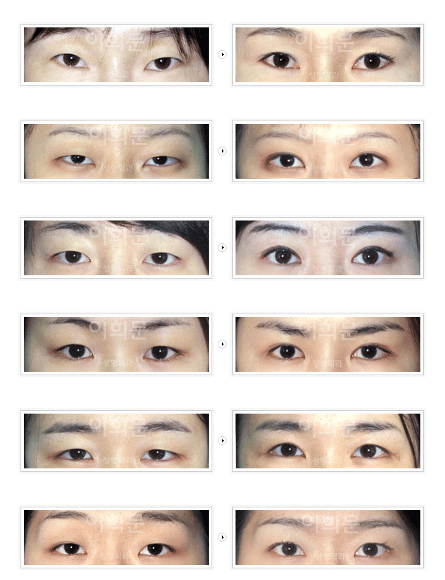 常见的几种类型的眼睛